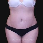 Tummy Tuck Before & After Patient #10750
