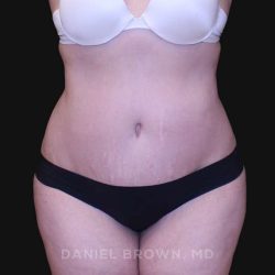 Tummy Tuck Before & After Patient #10750