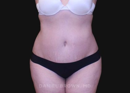Tummy Tuck Before & After Patient #10750