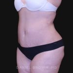 Tummy Tuck Before & After Patient #10750