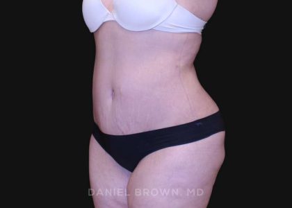 Tummy Tuck Before & After Patient #10750