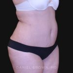 Tummy Tuck Before & After Patient #10750
