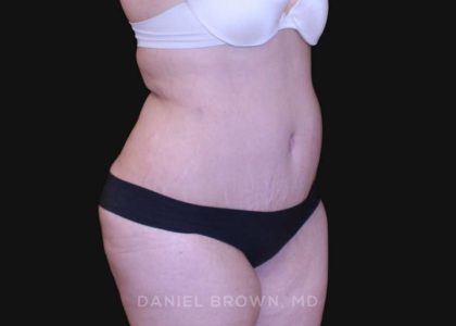 Tummy Tuck Before & After Patient #10750