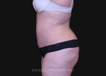 Tummy Tuck Before & After Patient #10750