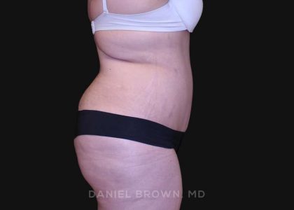 Tummy Tuck Before & After Patient #10750