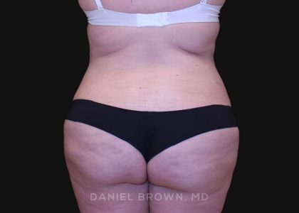 Tummy Tuck Before & After Patient #10750