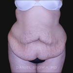 Tummy Tuck Before & After Patient #10750