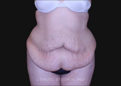 Tummy Tuck Before & After Patient #10750