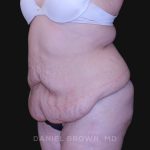 Tummy Tuck Before & After Patient #10750