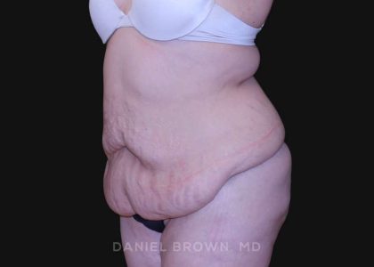 Tummy Tuck Before & After Patient #10750