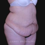 Tummy Tuck Before & After Patient #10750