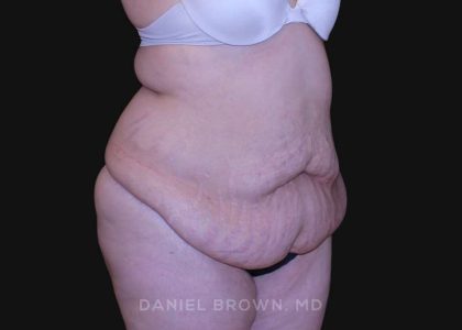 Tummy Tuck Before & After Patient #10750