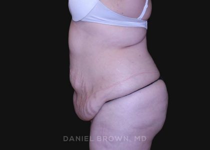 Tummy Tuck Before & After Patient #10750