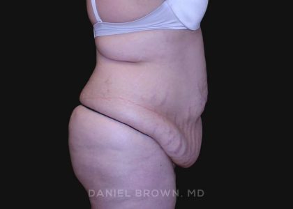 Tummy Tuck Before & After Patient #10750