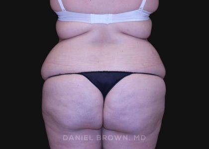 Tummy Tuck Before & After Patient #10750