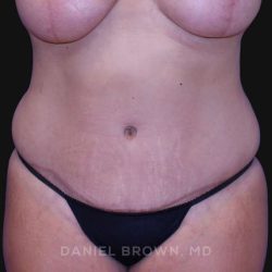 Tummy Tuck Before & After Patient #10763