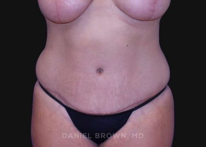 Tummy Tuck Before & After Patient #10763