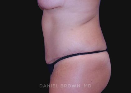 Tummy Tuck Before & After Patient #10763