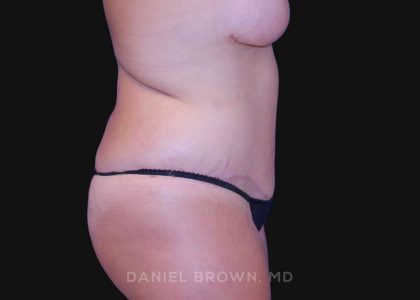 Tummy Tuck Before & After Patient #10763