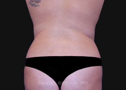 Tummy Tuck Before & After Patient #10763