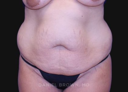Tummy Tuck Before & After Patient #10763