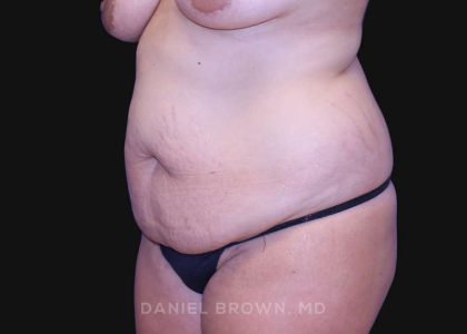 Tummy Tuck Before & After Patient #10763