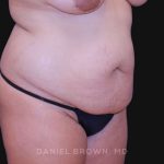 Tummy Tuck Before & After Patient #10763