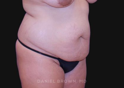 Tummy Tuck Before & After Patient #10763