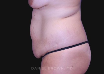 Tummy Tuck Before & After Patient #10763