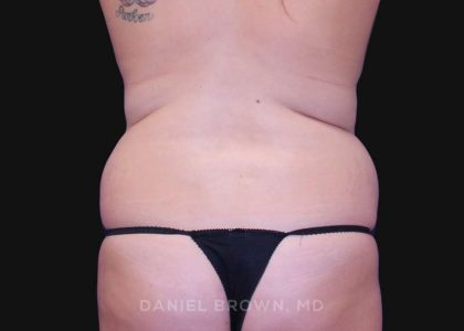 Tummy Tuck Before & After Patient #10763