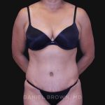 Tummy Tuck Before & After Patient #10774