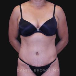 Tummy Tuck Before & After Patient #10774