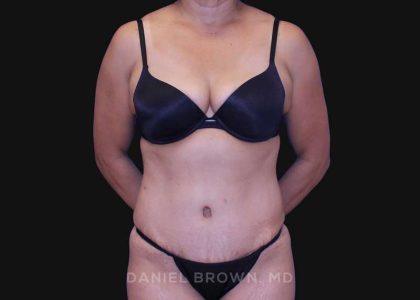 Tummy Tuck Before & After Patient #10774