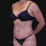 Tummy Tuck Before & After Patient #10774