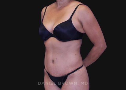 Tummy Tuck Before & After Patient #10774