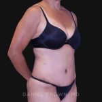 Tummy Tuck Before & After Patient #10774