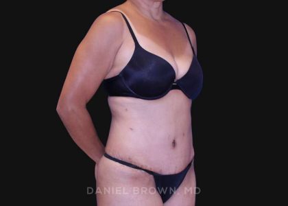Tummy Tuck Before & After Patient #10774