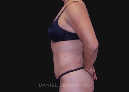 Tummy Tuck Before & After Patient #10774