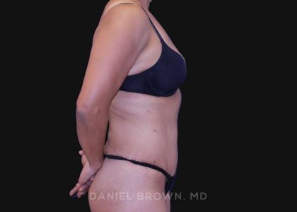 Tummy Tuck Before & After Patient #10774