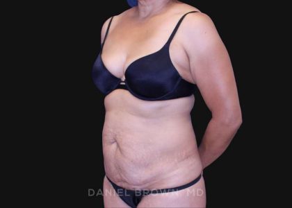 Tummy Tuck Before & After Patient #10774