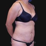 Tummy Tuck Before & After Patient #10774