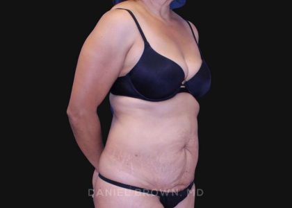 Tummy Tuck Before & After Patient #10774