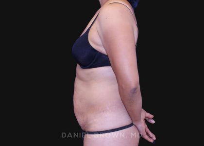 Tummy Tuck Before & After Patient #10774