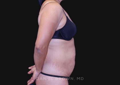 Tummy Tuck Before & After Patient #10774
