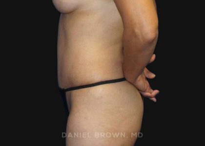 Tummy Tuck Before & After Patient #10781