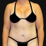 Tummy Tuck Before & After Patient #10788