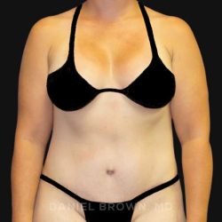 Tummy Tuck Before & After Patient #10788