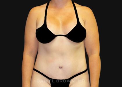 Tummy Tuck Before & After Patient #10788