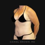Tummy Tuck Before & After Patient #10788