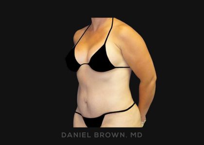 Tummy Tuck Before & After Patient #10788
